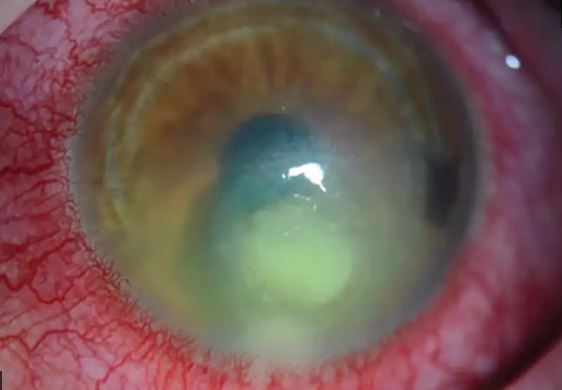 Contact Lens related infections