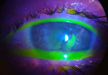 Finger nail scratching surface of eye