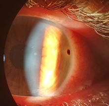 Foreign metal particles in eye from grinding metal