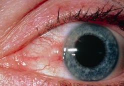 Sun burn-UV burn to eye 1