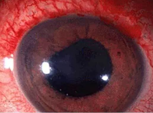 Systemic inflammation (Auto immune)