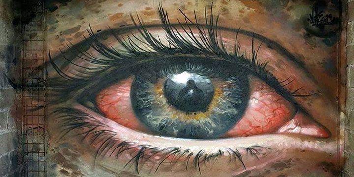 Conjunctivitis